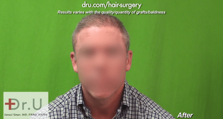 Front view of Norwood 6 FUE results after Dr.UGraft Front view of Norwood 6 FUE results after Dr.UGraft