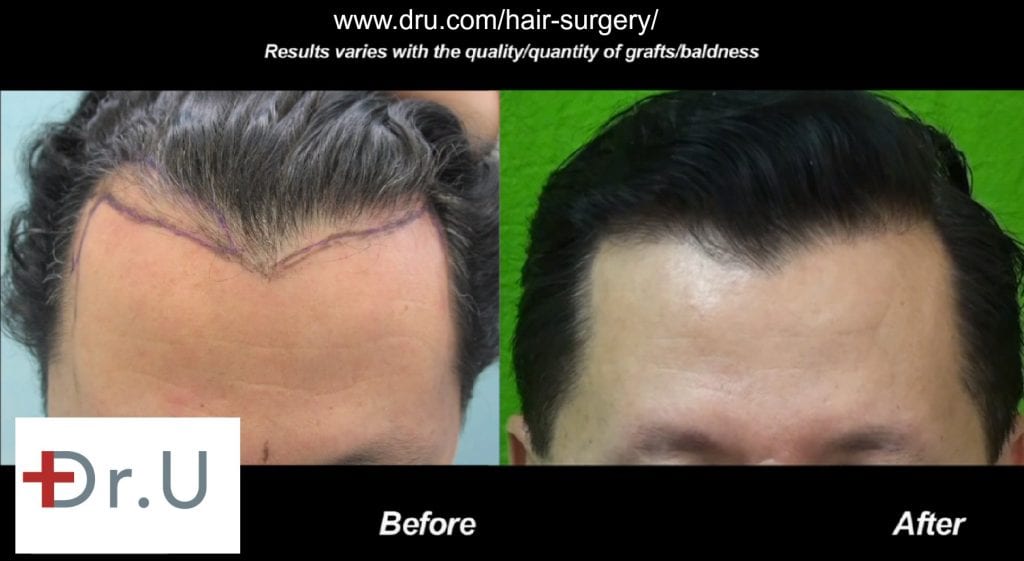 Hairline growth is healthy due to the successful survival of inserted grafts Hairline growth is healthy due to the successful survival of inserted grafts