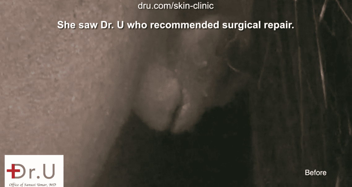 Patient before surgery to repair split earlobe.