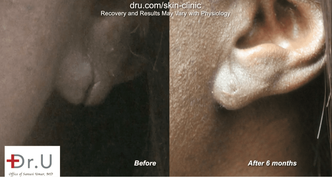 Earlobe surgery before and after the procedure was done. The patient was pleased with her earlobe surgery*