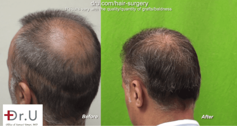 Side view of corrective hair surgery for strip scar Side view of patient's results to cover strip scar linear wound using face hair to head transplant grafts