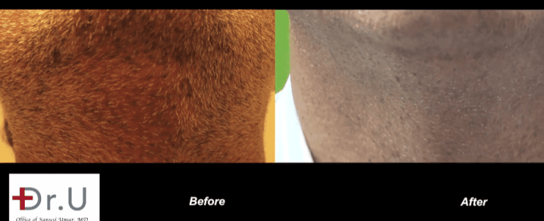 Cosmetically insignificant scarring of beard donor area after Dr.UGraft FUE corrective hair surgery Cosmetically insignificant scarring of beard donor area after Dr.UGraft FUE corrective hair surgery