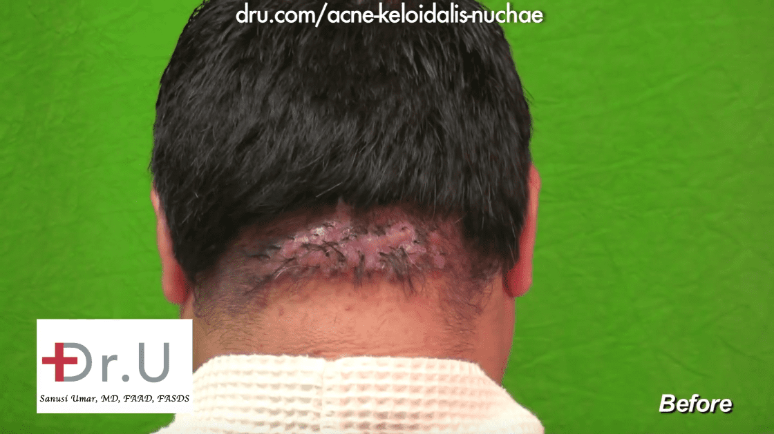 VIDEOAcne Keloidalis Nuchae Surgical Cure for New York Patient Of Dr U