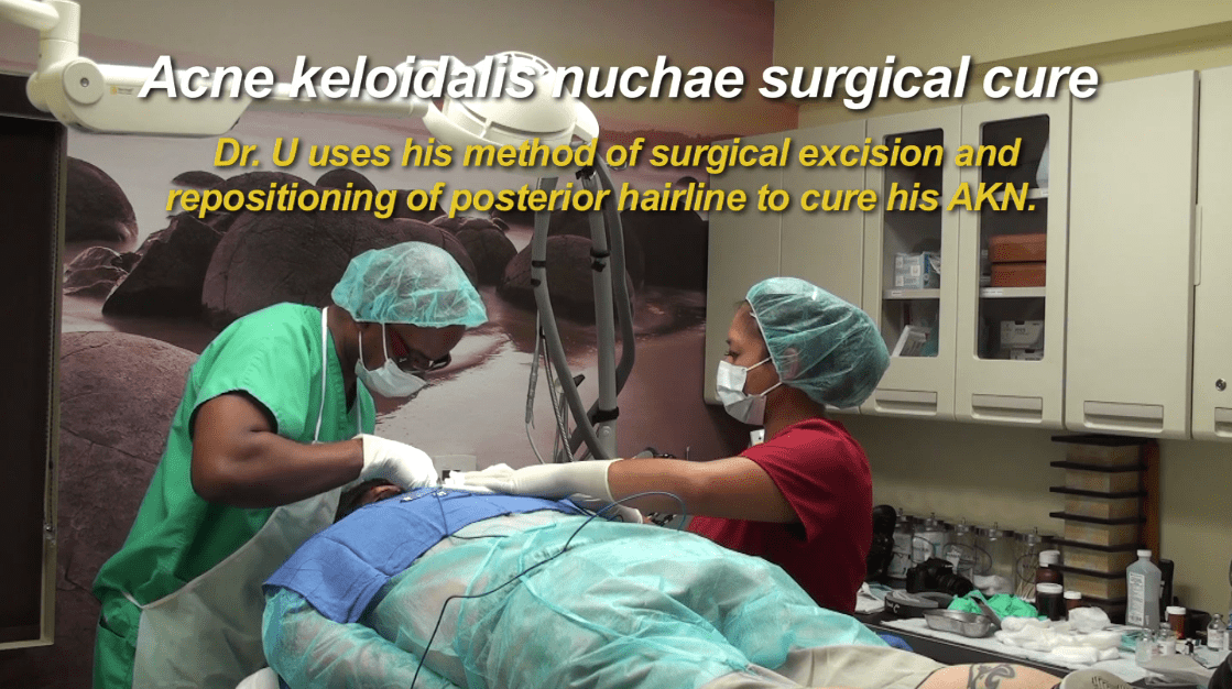 To remove AKN razor bump completely in this Chicago patient, Dr. Umar would use his singular excision technique To remove AKN razor bump completely in this Chicago patient, Dr. Umar would use his singular excision technique