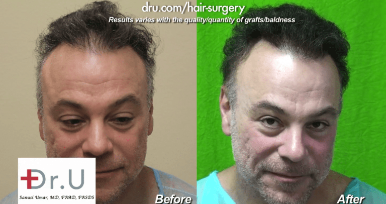 Skin thickness differences for FUE transplant also resides across body donor areas within the same individual. The Dr.UGraft Intuitive FUE technology addresses these differences, making it possible to extract grafts from regions like the face and nec. This patient's final results were created entirely from beard hair. Skin thickness differences for FUE transplant also resides across body donor areas within the same individual. The Dr.UGraft Intuitive FUE technology addresses these differences, making it possible to extract grafts from regions like the face and nec. This patient's final results were created entirely from beard hair.