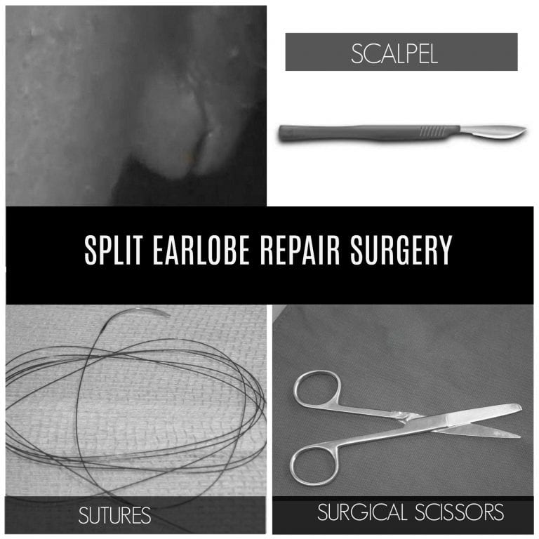 A torn earlobe procedure requires the use of simple tools to repair the split A torn earlobe surgery requires the use of simple tools to repair the split