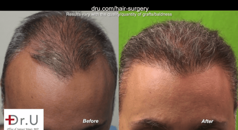 Results of hair surgery to reconstruct hairline and temples for past strip procedure mistakes. Patient shows excellent growth in both areas Results of hair surgery to reconstruct hairline and temples for past strip procedure mistakes. Patient shows excellent growth in both areas