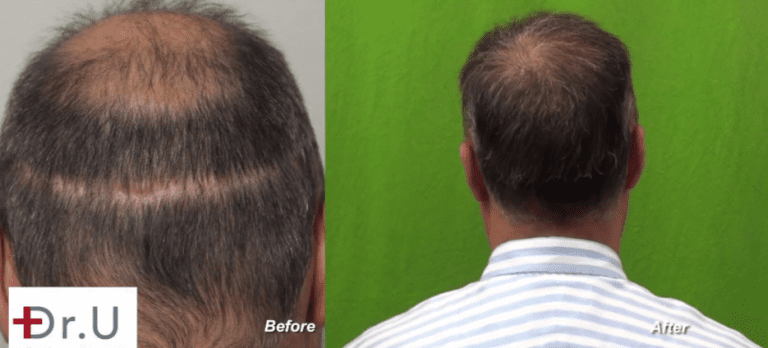 Results of the Dr.UGraft™ hair repair to cover strip scar Results of the Dr.UGraft™ hair repair to cover strip scar