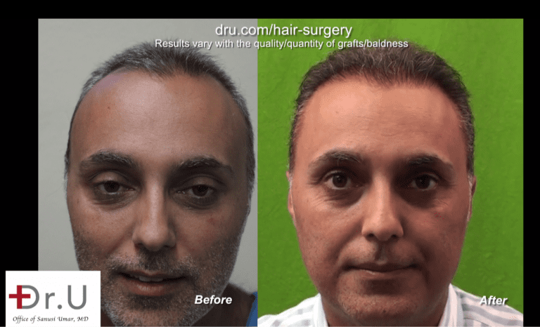 Front view of patient who underwent a face to head hair transplant with Dr. Umar for to fix his unsuccessful hair transplant from a previous strip surgery clinic Front view of patient who underwent a face to head hair transplant with Dr. Umar for to fix his unsuccessful hair transplant from a previous strip surgery clinic