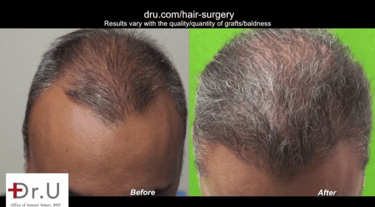 FUE corrective hair surgery results showing excellent yield on top of patient's head FUE corrective hair surgery results showing excellent yield on top of patient's head