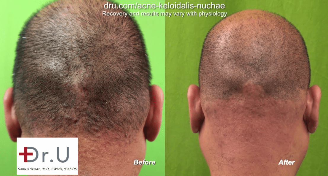 Video Los Angeles Acne Keloidalis Nuchae Laser Treatment Cure By Dr U