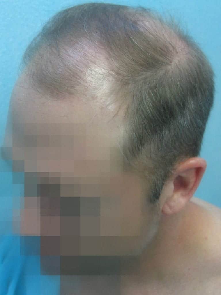 Norwood 6 - Severely Bald Patient Needing High Graft Count Norwood 6 - Severely Bald Patient Needing High Graft Count