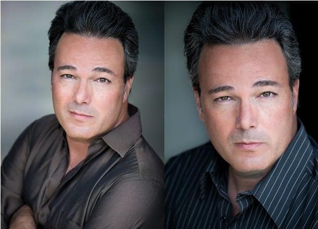 Beverly Hills patient shown 9 years following his hairline reconstruction using leg hair Beverly Hills patient shown 9 years following his hairline reconstruction using leg hair