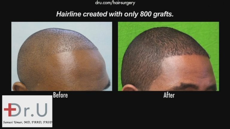 FUE transplant in black patients for hairline reconstruction also requires the creation of appropriately shaped temple points FUE transplant in black patients for hairline reconstruction also requires the creation of appropriately shaped temple points
