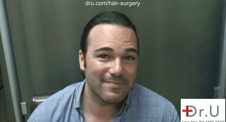 Beverly Hills patient shown two year after his hairline reconstruction using leg hair Beverly Hills patient shown two year after his hairline reconstruction using leg hair