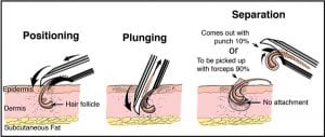 The Dr.UPunch Curl can follow the curvature of the hair follicles that are found in black patients. The Dr.UPunch Curl can follow the curvature of the hair follicles that are found in black patients.