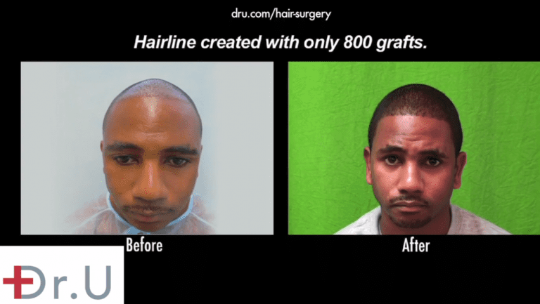 FUE hair transplantation for African Americans can produce amazing coverage if the grafts are safely and successfully harvested. Advanced tools like the Dr.UPunch Curl ™ allow this type of reliable growth to become possible FUE hair transplantation for African Americans can produce amazing coverage if the grafts are safely and successfully harvested. Advanced tools like the Dr.UPunch Curl ™ allow this type of reliable growth to become possible