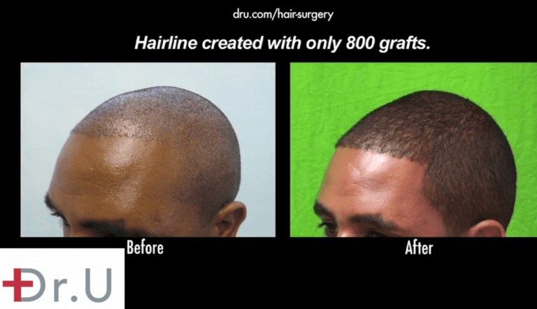 Receding hairlines in black men can be reversed using grafts that are successfully harvested using specialized extraction tools like the Dr.UPunch Curl ™ Receding hairlines in black men can be reversed using grafts that are successfully harvested using specialized extraction tools like the Dr.UPunch Curl ™ *