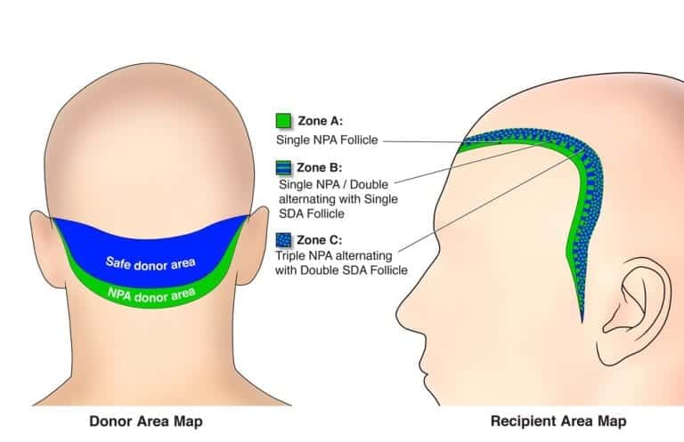 To recreate hairlines and temples in a celebrity or other individual, softer nape hair can be inserted to recreate a naturally soft looking edge To recreate hairlines and temples in a celebrity or other individual, softer nape hair can be inserted to recreate a naturally soft looking edge