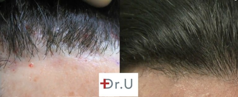 Patient's hairline reconstruction using leg hair produced more natural looking hairline restoration results, as shown in these before and after photos Patient's hairline reconstruction using leg hair produced more natural looking hairline restoration results, as shown in these before and after photos