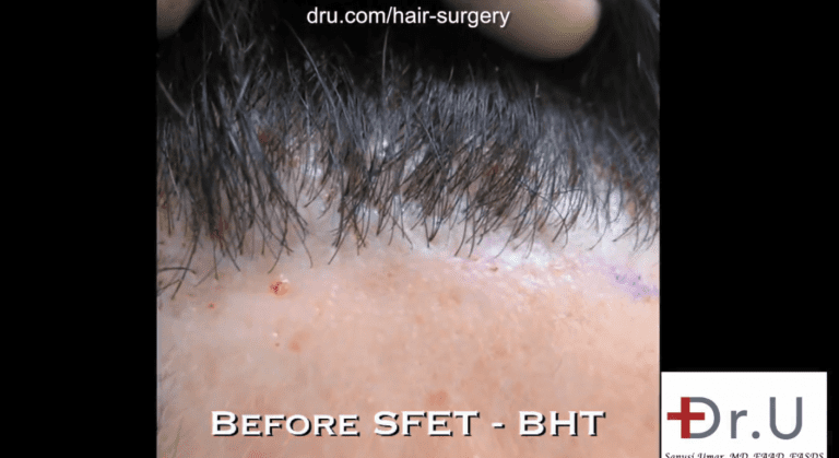 Patient before his procedure with Dr. Umar to reverse poor hairline restoration results. Hairline shows obvious looking plugs due to the use of large sized punches Patient before his procedure with Dr. Umar to reverse poor hairline restoration results. Hairline shows obvious looking plugs due to the use of large sized punches