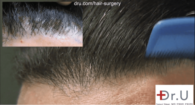 Before and after photos showing a successful outcome to correct the patient's pluggy hairline using leg hair Before and after photos showing a successful outcome to correct the patient's pluggy hairline using leg hair