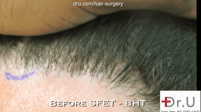 Dr. Umar recommended a hairline reconstruction using leg hair to correct the unnatural looking clustering of hair Dr. Umar recommended a hairline reconstruction using leg hair to correct the unnatural looking clustering of hair