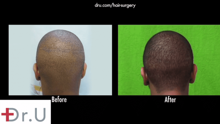 hair loss in black men should be addressed with advanced FUE performed with tools like the Dr.UPunch Curl™ to avoid the creation of linear strip scars. However, with the right FUE procedures, it is possible to insert hair follicle grafts into the scar tissue to render it less visible, enabling successful hair transplant repair in African American individuals hair loss in black men should be addressed with advanced FUE performed with tools like the Dr.UPunch Curl™ to avoid the creation of linear strip scars. However, with the right FUE procedures, it is possible to insert hair follicle grafts into the scar tissue to render it less visible, enabling successful hair transplant repair in African American individuals