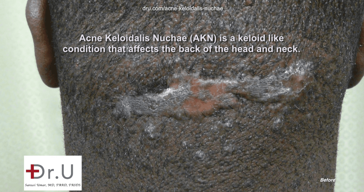 Surgical removal of AKN lump would be necessary after steroid injections Surgical removal of AKN lump would be necessary after steroid injections failed.*