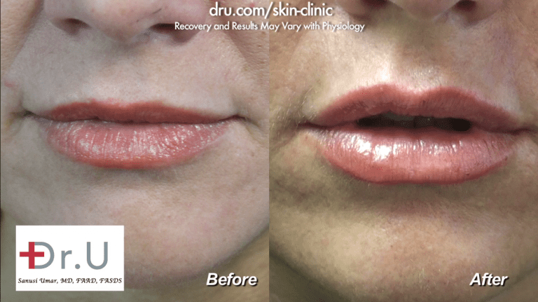Before and after photos of a lip augmentation for the cupid's bow