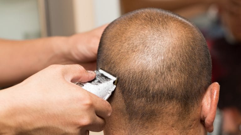 Have you noticed bumps on your head after a shave? While it may be tempting to brush off these bumps as just a barber's rash, they could be symptoms of a skin condition known as AKN. Have you noticed bumps on your head after a shave? While it may be tempting to brush off these bumps as just a barber's rash, they could be symptoms of a skin condition known as AKN.