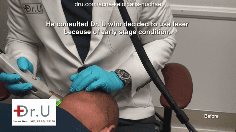 Dr. Umar treats this patient's itchy bumps on the head with laser therapy, since the condition was caught early on. Dr. Umar treats this patient's itchy bumps on the head with laser therapy, since the condition was caught early on.