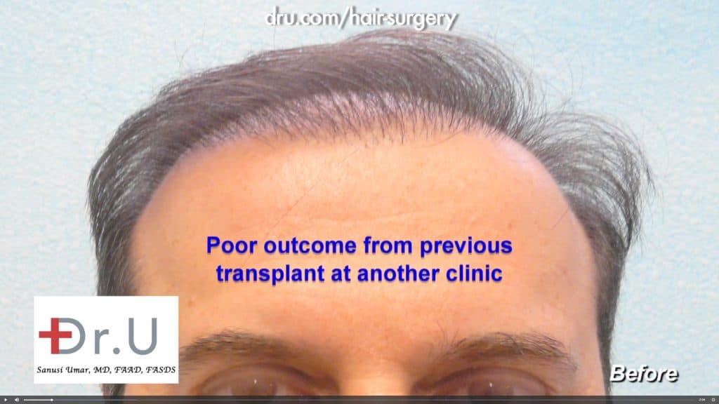 patient hopes to fix pluggy hairline with body hair grafts This patient chose Dr. Umar to fix a pluggy hairline that resulted from a past hair transplant procedure