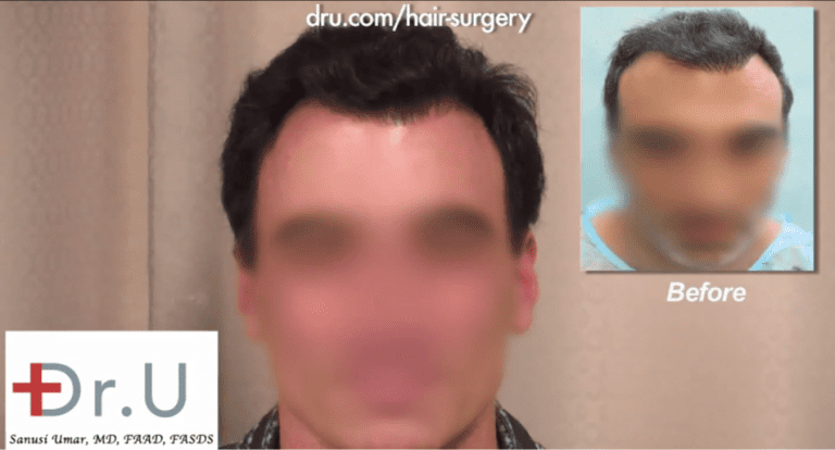 Palos Verdes, Los Angeles patient before and after his repair for an asymmetrical hairline Palos Verdes, Los Angeles patient before and after his asymmetrical hairline repair
