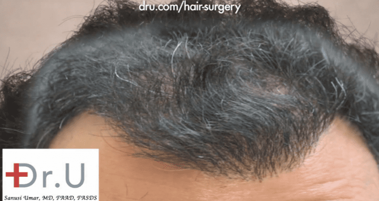 Palos Verdes, Los Angeles patient before his repair for an asymmetrical hairline Palos Verdes, Los Angeles patient before his repair for an asymmetrical hairline