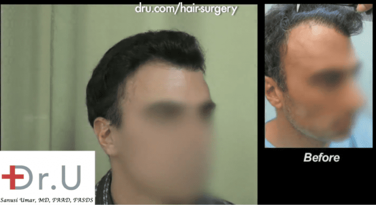 Palos Verdes patient showing the results of his hairline revision surgery which also included improvements in his temple area Palos Verdes patient showing the results of his hairline revision surgery which also included improvements in his temple area