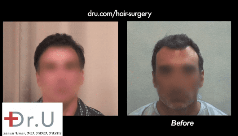 asymmetrical pluggy hairline repair, fix a botched hairline, how to fix a crooked hairline, hairline repair with FUE, hairline revision surgery asymmetrical pluggy hairline repair, fix a botched hairline, how to fix a crooked hairline, hairline repair with FUE, hairline revision surgery