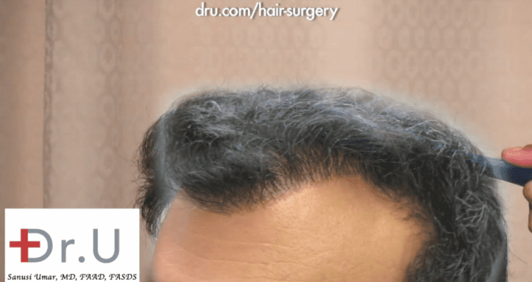 Patient before his temple and hairline revision surgery with FUE Patient before his temple and hairline revision surgery with FUE