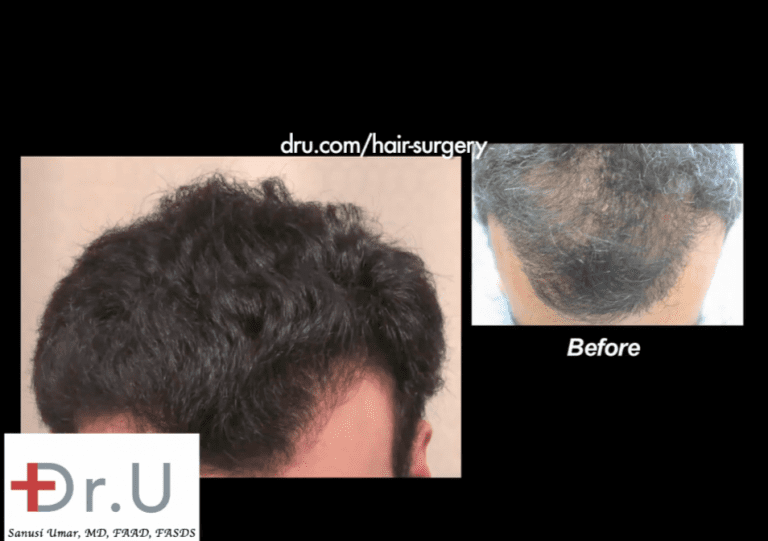 Dr. Umar's hairline repair with FUE also included addressing other areas like the sparse top shown here Dr. Umar's hairline repair with FUE also included addressing other areas like the sparse top shown here