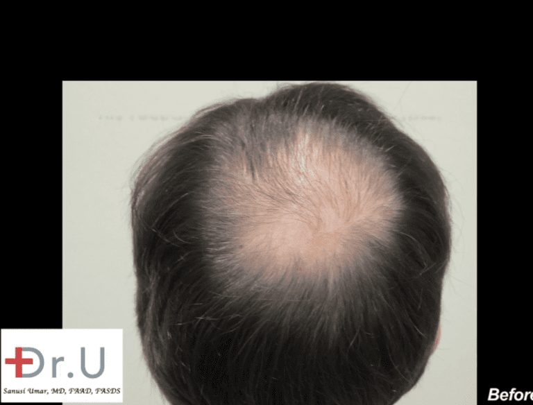 Bernardo hoped to restore a balding crown on the back of his head Bernardo hoped to restore a balding crown on the back of his head