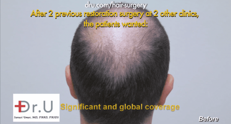 Despite undergoing two past procedures, this patient struggled with no growth after strip surgery Despite undergoing two past procedures, this patient struggled with no growth after strip surgery