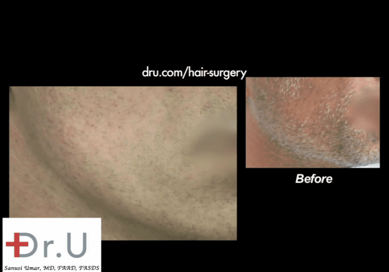 Patient's beard donor area shows amazing healing results Patient's beard donor area shows amazing healing results