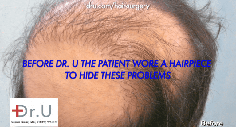 No hair growth yield, oddly placed grafts caused this patient to wear a toupee for 14 years No hair growth yield, oddly placed grafts caused this patient to wear a toupee for 14 years