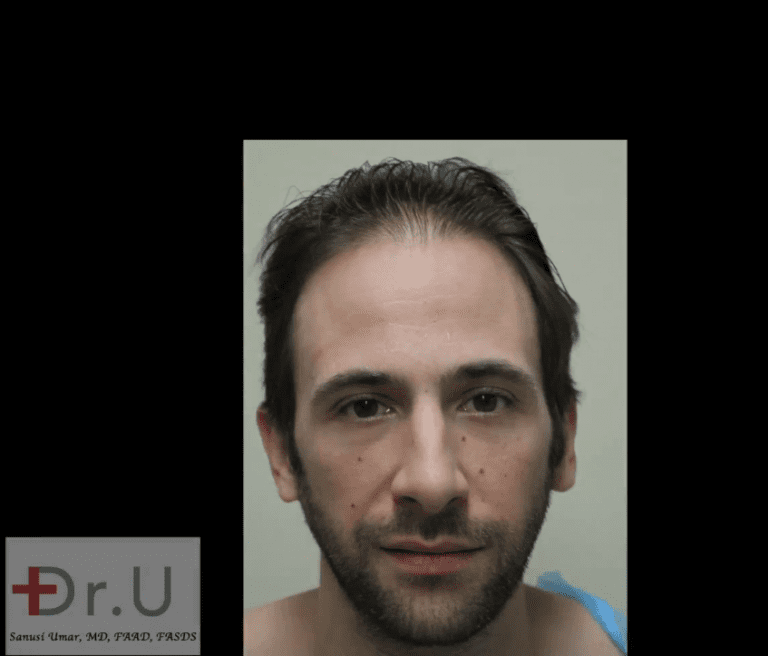 Celebrity hair restoration patient showing a receded hairline and temples before his procedure with Dr. Umar Celebrity hair restoration patient showing a receded hairline and temples before his procedure with Dr. Umar