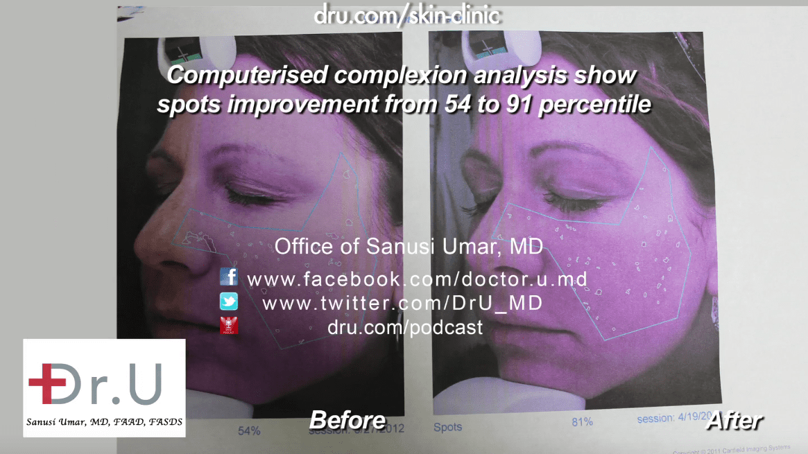 A single Fraxel Dual laser treatment allows doctors to remove age spots fast A single Fraxel Dual laser treatment allows doctors to remove age spots fast
