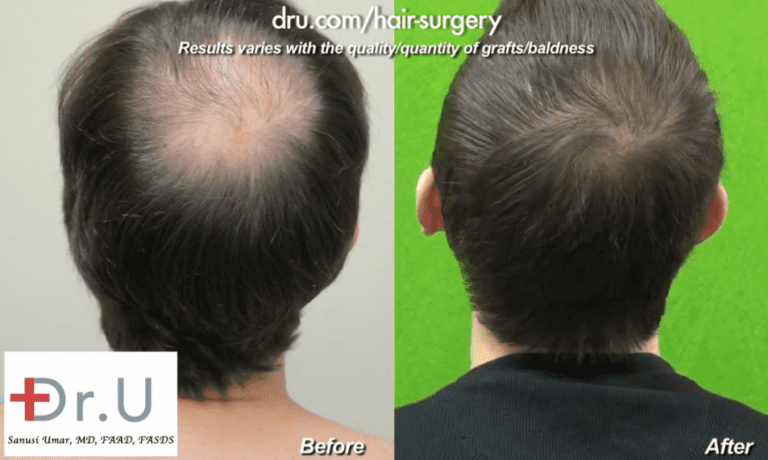 Hollywood, Los Angeles patient shown from the side before and after his celebrity hair restoration Hollywood, Los Angeles patient shown from the side before and after his celebrity hair restoration