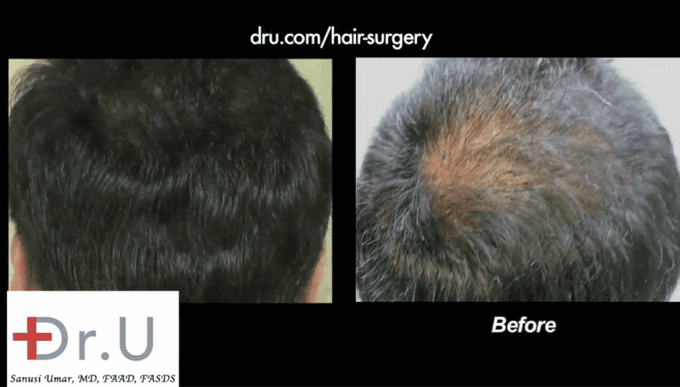 Beard hair grafts were inserted into the patient's sparse crown to produce the abundant density shown here Beard hair grafts were inserted into the patient's sparse crown to produce the abundant density shown here