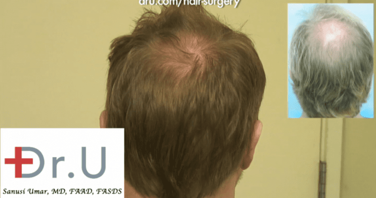 crown hair loss reversed along with treatment for advanced hairline recession crown hair loss reversed along with treatment for advanced hairline recession