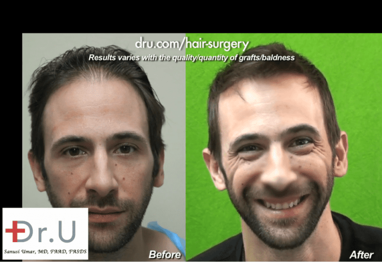 Hair restoration can be a transformational course of action when it comes to image management for celebrities Hair restoration can be a transformational course of action when it comes to image management for celebrities