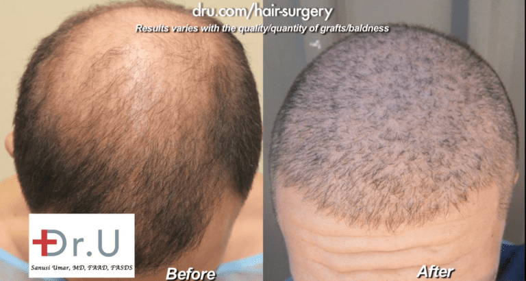Sydney, Australia patient showed no growth after strip surgery but overcame this issue with 13,000 grafts of head and body hair Sydney, Australia patient showed no growth after strip surgery but overcame this issue with 13,000 grafts of head and body hair